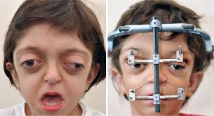 Resultado de imagen para sindrome de alexander