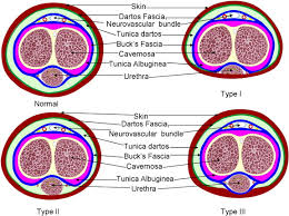 Image result for Chordee