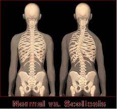 Normal Spine Vs Scoliosis Spine Scoliosis Scoliosis Exercises Scoliosis Treatment