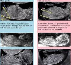 If patients decide against nipt then a gender determination scan can be performed from 16 weeks onward. When Do You Find Out Gender Ovulation Signs