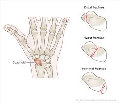 Image result for Scaphoid Fracture Signs