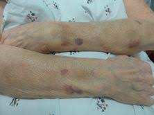 Prolonged exposure to sunlight may also cause skin cancer. Dermatologic Conditions In The Elderly Oncohema Key