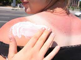 Hausmittel Gegen Sonnenbrand Was Wirklich Hilft Und Wovon Sie Besser Die Finger Lassen Gesundheit