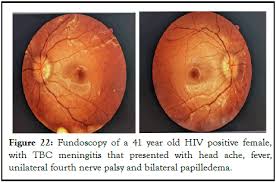 Image result for HIV Retinitis