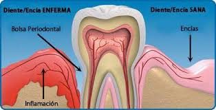 Resultado de imagen de periodontitis juvenil