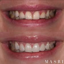 How Can I Fix My Canted Smile? : R/Invisalign