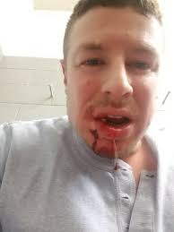 In 2009, Ian Laperriere took a slap shot to the face late in the first  period of the game against the Buffalo Sabres. He lost seven teeth, broke a  bone above his