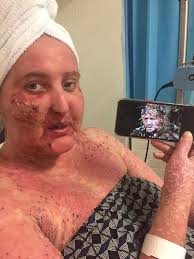 Woman contracted skin condition while travelling in Australia which left  her 'looking like Deadpool'