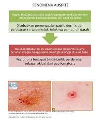 Image result for Auspitz Sign