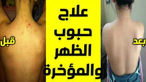 خل التفاح لحبوب الظهر والصدر علاج حبوب الظهر والكتف والصدر علاج دمامل playbill