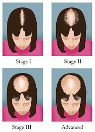 I think of growing hair much like anything that grows in that all requirements must be met for optimal growth. Is Female Pattern Hair Loss Reversible Cyber Hairsure
