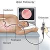 Colonoscopy is a test performed by an expert to check for abnormalities in the colon. 1