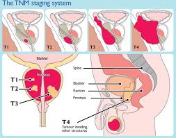 Image result for Prostate Cancer Staging