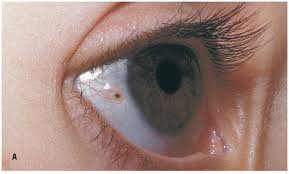 Image result for nevus sclerae