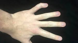 We did not find results for: Brachydactyly Types Diagnosis Treatment And More