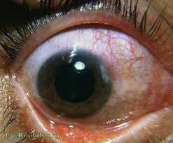 Keratitis is a painful eye inflammation that can be very serious. Corneal Marginal Ulcer Marginal Keratitis With Ulceration In A 45 Year Old Male