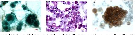 Effusion cytology for differential diagnosis of malignant pleural mesothelioma and adenocarcinoma uses immunostaining panels with mesothelial . Figure 6 From Use Of Liquid Based Cytology Lbc And Cell Blocks From Cell Remnants For Cytologic Immunohistochemical And Immunocytochemical Diagnosis Of Malignancy Semantic Scholar