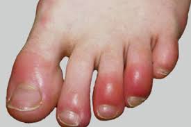 Image result for Chilblains