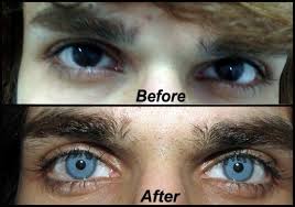 Controversial Artificial Iris Implant Surgery To Permanently Change Eye Colour Eye Color Change Eye Color Green Eyes