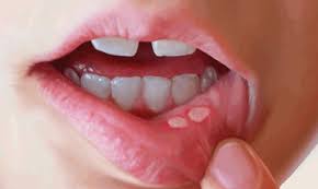 Though most throat cancers involve the same types of cells, specific terms are used to differentiate the part of the throat where cancer originated. Signs And Symptoms You Could Have Mouth Cancer Oral Cancer