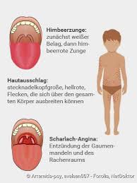 Scharlach Symptome Ansteckung Therapie Netdoktor