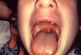 Image result for Strep throat infection roof of mouth