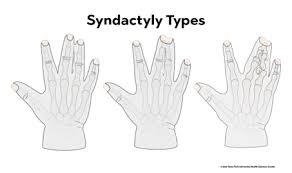 Image result for Syndactyly