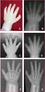 Photographs and radiographs of the hands for Patient 3 (A,B), Patient 4... | Download Scientific Diagram