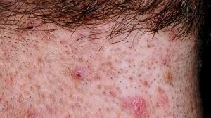 In some cases, the hair can be seen growing under the surface of the skin. Infected Ingrown Hair Pictures Treatment Removal And More