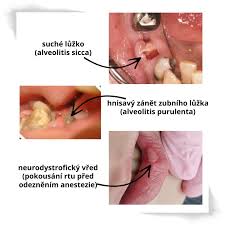 Image result for Alveolitis sicca)