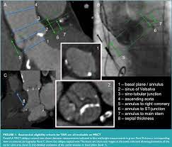 This page is about the various possible meanings of the acronym, abbreviation, shorthand or slang term: Figure 1 From Multislice Computer Tomography Msct For The Optimisation Of Transcatheter Aortic Valve Implantation Tavi Semantic Scholar