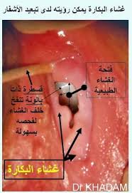 نصائح صحية ـ البكارة دكتور لؤي خدام Cabinet De Gynecologue Femme Facebook
