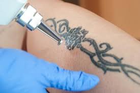 Following these recommended tattoo removal aftercare instructions can have a real impact on the outcome of your treatment. Laser Tattoo Removal Aftercare Instructions Lovetoknow
