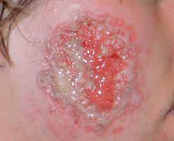 "Leishmaniasis-Causes-</a
