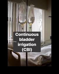 Image result for Continuous Bladder Irrigation
