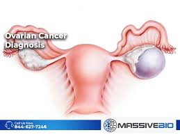 Common symptoms of ovarian cancer include bloating, pelvic pain, feeling full quickly, and urinary symptoms. Ovarian Cancer Diagnosis Grades Of Ovarian Tumors Massive Bio