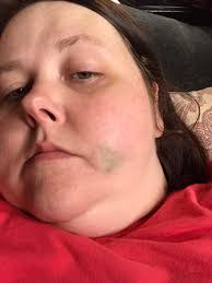 Hi everyone!! Just giving an update! I had a bone graph done