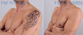 However, this isn't all done with just one treatment. Tatto Wallpapers Removal Of Tattoos At Home
