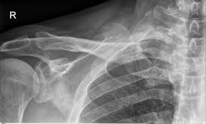 Image result for SC Dislocation