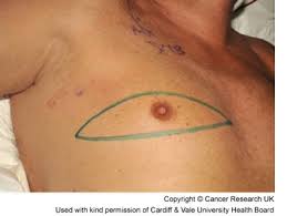 The results of earlier medical tests. Breast Cancer In Men Cancer Research Uk