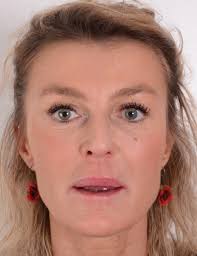 Clinical case: Full-mouth rehabilitation using multiple types of Zirconia