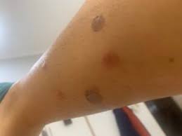 Image result for Papular urticaria