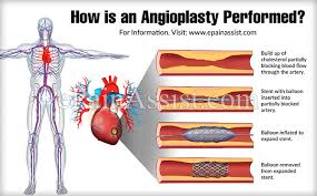 Angioplasty is a keyhole surgery procedure for repairing damaged or diseased blood vessels. How Is An Angioplasty Performed Types Benefits Of Angioplasty