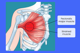 Are purple breasts a sign of inflammatory breast cancer concern