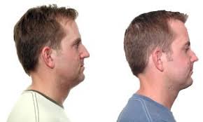 Image result for jaw surgery