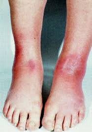 Image result for erythema nodosum