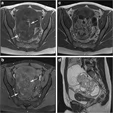 Publications by authors named caroline c c hulsker. Mr Imaging In Discriminating Between Benign And Malignant Paediatric Ovarian Masses A Systematic Review Springerlink