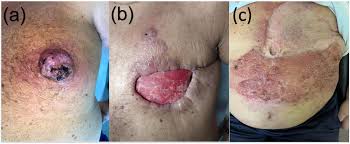 Image result for Merkel Cell Carcinoma