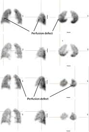 Image result for Ventilation Perfusion Scan