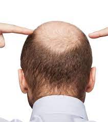 Some people prefer to let their hair loss run its course untreated and hair loss can appear in many different ways, depending on what's causing it. Common Hair Loss Causes And Hair Loss Treatment Options Parsa Mohebi Hair Restoration